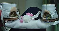 صورة طبية: طريقة بونستي لعلاج القدم الحنفاء الخلقية: دليل شامل للمرضى