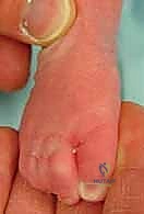 صورة طبية: طريقة بونستي لعلاج القدم الحنفاء الخلقية: دليل شامل للمرضى