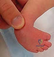 عوامل خطر القدم الحنفاء