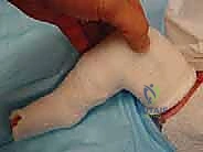 الجبيرة الأولى لتصحيح التقوس