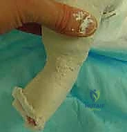 تطبيق الجبس المتسلسل