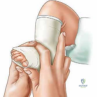 صورة توضيحية لـ طريقة بونستي لعلاج القدم الحنفاء الخلقية: دليل شامل للمرضى