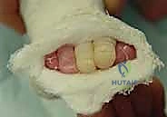 صورة توضيحية لـ طريقة بونستي لعلاج القدم الحنفاء الخلقية: دليل شامل للمرضى