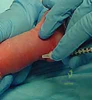 صورة توضيحية لـ طريقة بونستي لعلاج القدم الحنفاء الخلقية: دليل شامل للمرضى