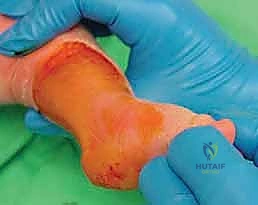 صورة توضيحية لـ طريقة بونستي لعلاج القدم الحنفاء الخلقية: دليل شامل للمرضى