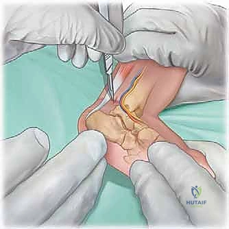 القدم بعد الجبائر