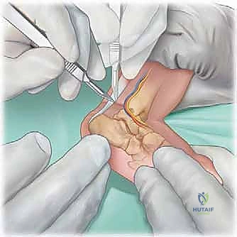 صورة توضيحية لـ طريقة بونستي لعلاج القدم الحنفاء الخلقية: دليل شامل للمرضى