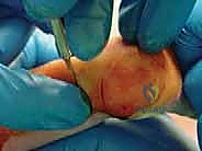 صورة توضيحية لـ طريقة بونستي لعلاج القدم الحنفاء الخلقية: دليل شامل للمرضى