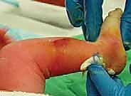 دعامة دنيس براون