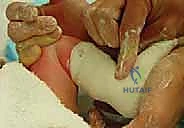 الجبيرة النهائية بعد القطع