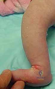 صورة طبية: طريقة بونستي لعلاج القدم الحنفاء الخلقية: دليل شامل للمرضى