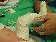 صورة توضيحية لـ طريقة بونستي لعلاج القدم الحنفاء الخلقية: دليل شامل للمرضى