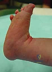 Illustration of percutaneous achilles tenotomy - Dr. Mohammed Hutaif