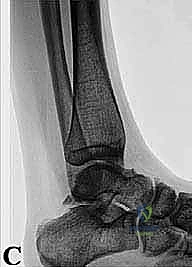 صورة توضيحية لـ تنظير الكاحل الخلفي والمنظار الجراحي للقدم الخلفية