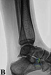 الهياكل العظمية في الكاحل