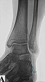 تشريح الكاحل الخلفي