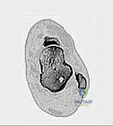 صورة من داخل الكاحل عبر المنظار