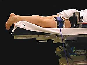 استئصال العظم الزائد