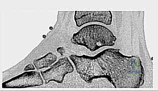 متلازمة العظم الزائد