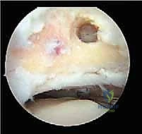 صورة توضيحية لـ تنظير الكاحل الخلفي والمنظار الجراحي للقدم الخلفية: حلول متقدمة لآلام الكاحل المعقدة في صنعاء مع الأستاذ الدكتور محمد هطيف