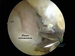 النتوءات العظمية