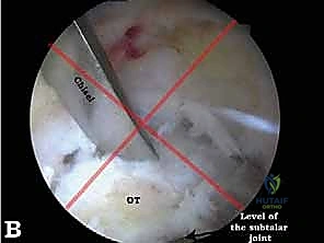 صورة طبية: تنظير الكاحل الخلفي والمنظار الجراحي للقدم الخلفية: حلول متقدمة لآلام الكاحل المعقدة في صنعاء مع الأستاذ الدكتور محمد هطيف