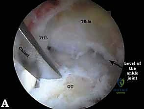 آفات الغضروف العظمي