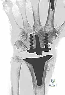 تأثير الروماتويد على مفصل الرسغ