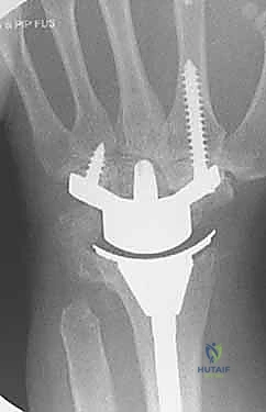 إصابات الرسغ القديمة وتأثيرها