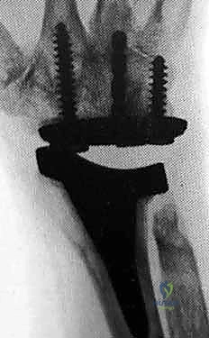 Wrist Implant Arthroplasty