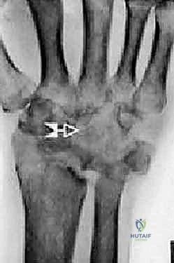 الأستاذ الدكتور محمد هطيف أستاذ جراحة العظام