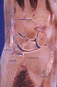 أعراض تلف مفصل الرسغ