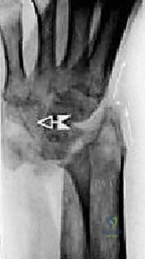 خبرة تتجاوز العقدين في جراحة المفاصل