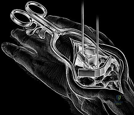 مقارنة بين دمج المفصل وزراعته