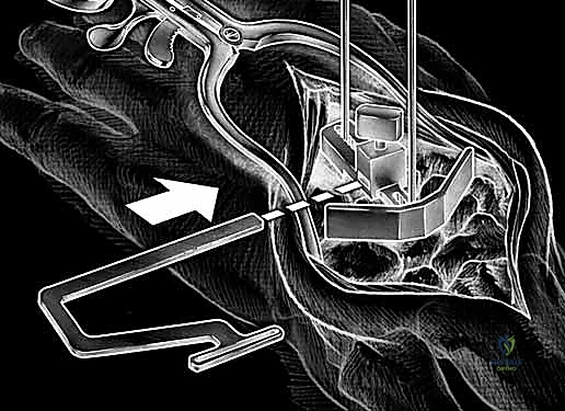 تشريح مفصل الرسغ المعقد