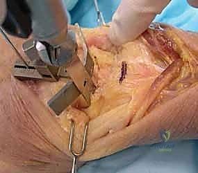 الخيارات العلاجية لآلام الرسغ