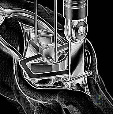 خشونة مفصل الرسغ المتقدمة