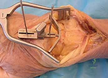 حلول متطورة لآلام الرسغ المزمنة في صنعاء