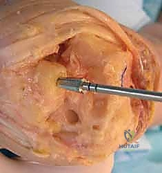 المفصل الصناعي للرسغ