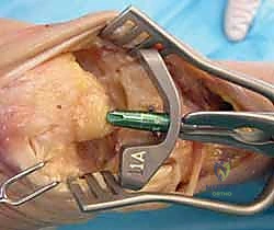 الوصول الجراحي الدقيق لمفصل الرسغ