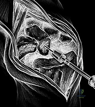 التخطيط الجراحي لزراعة مفصل الرسغ