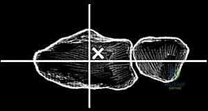 تثبيت مفصل الرسغ الصناعي النهائي