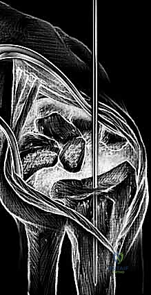 تجربة المفصل الصناعي المؤقت