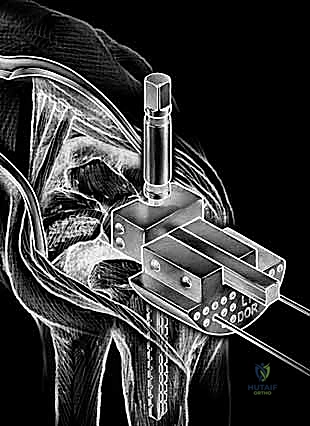 إزالة العظام التالفة من الرسغ