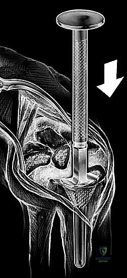 التحقق من حركة المفصل أثناء الجراحة