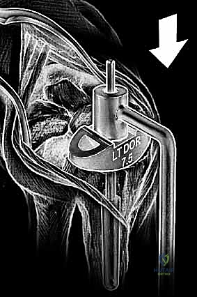 إغلاق الجرح التجميلي