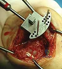 صورة أشعة لمفصل الرسغ بعد الزراعة