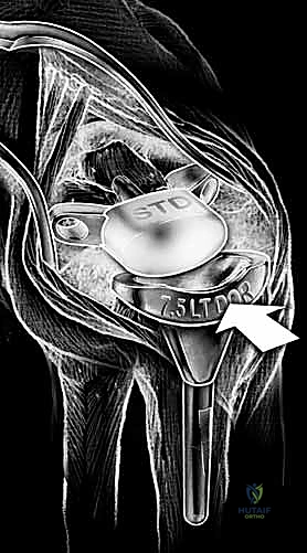 صورة توضيحية لـ زراعة مفصل الرسغ الصناعي: حلول متطورة لآلام الرسغ المزمنة في صنعاء مع الأستاذ الدكتور محمد هطيف