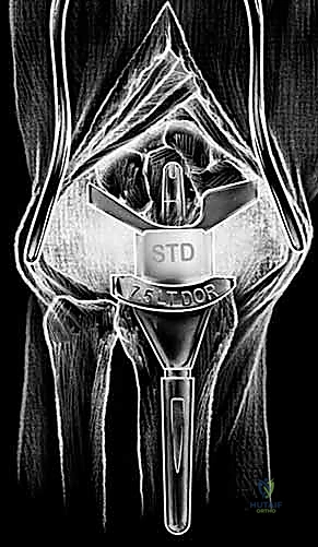 صورة توضيحية لـ زراعة مفصل الرسغ الصناعي: حلول متطورة لآلام الرسغ المزمنة في صنعاء مع الأستاذ الدكتور محمد هطيف