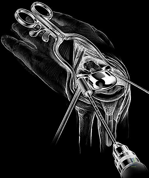 صورة توضيحية لـ زراعة مفصل الرسغ الصناعي: حلول متطورة لآلام الرسغ المزمنة في صنعاء مع الأستاذ الدكتور محمد هطيف